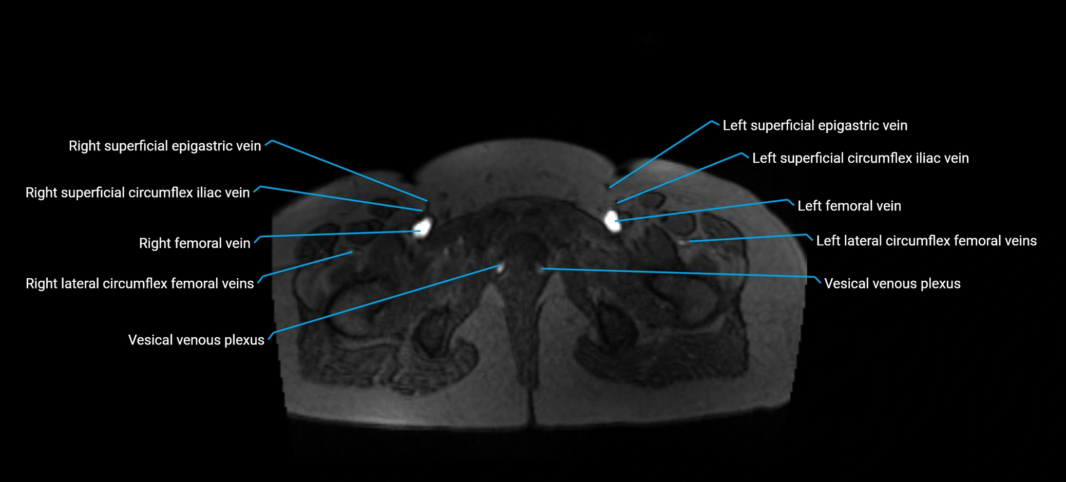 MRV abdomen pelvis & lower limb axial cross sectional anatomy labelled MRI image 192 (1).webp
